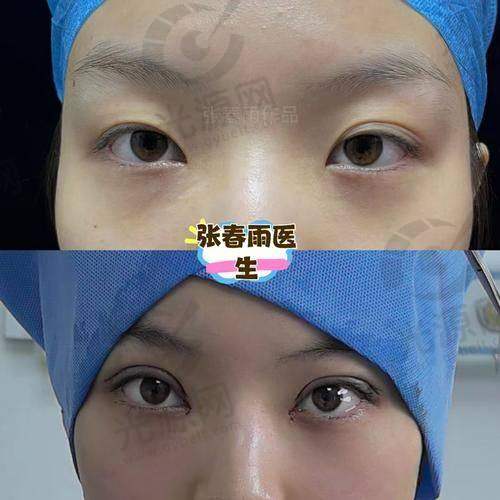 开外眼角后悔了应选择专精机构