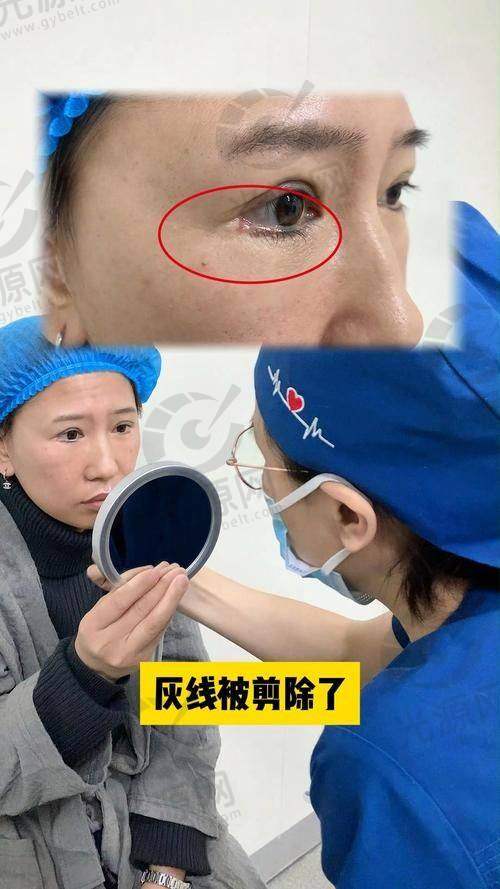 开外眼角后悔了实例分析
