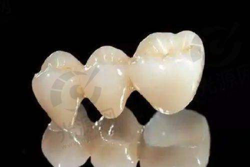隐适美几种类型：Invisalign Moderate 中等难度版本