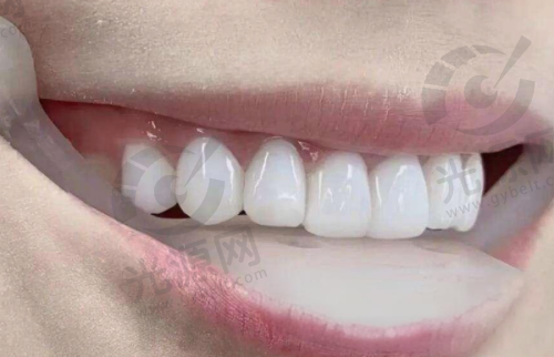 隐适美几种类型:Invisalign System - Comprehensive 复杂病例版本
