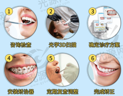 自锁牙套的种类和价格