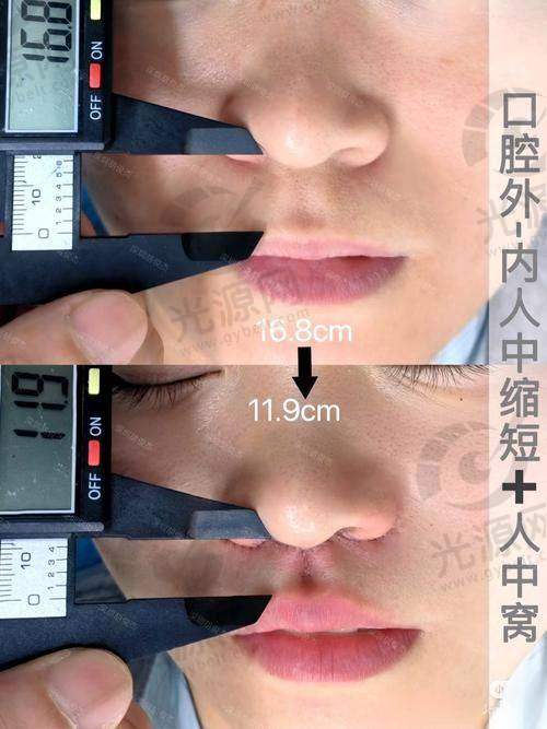 人中缩短术本身的风险