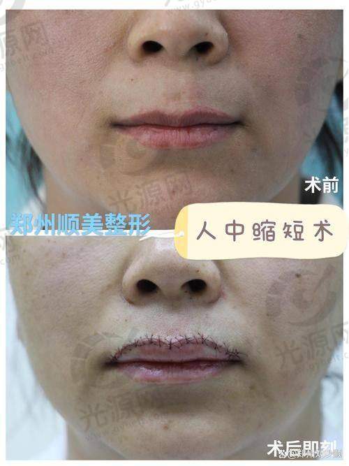 优先考虑其他自然改善办法