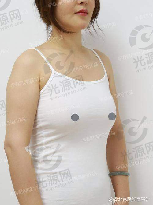 自体脂肪隆胸的成效维持时间