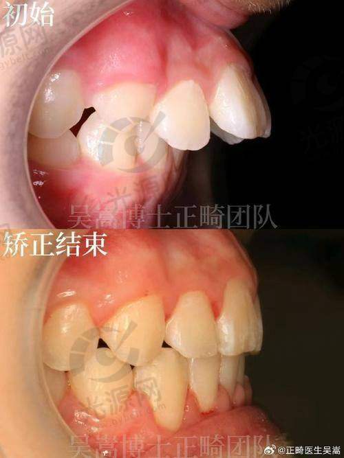 对刃颌的正畸治疗方案