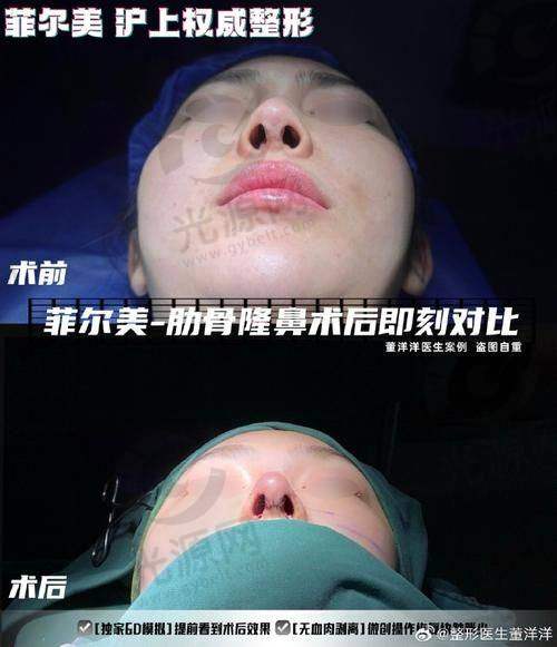 打了瘦脸针的成效与风险