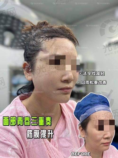 孙小应医生的整形实例
