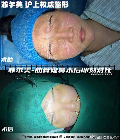 肖志波医生的吸脂技术与实例分析