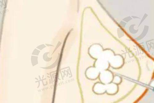 总结傲若拉毛面假体的性价比