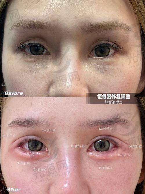 双眼皮手术失败的图片——肉条感