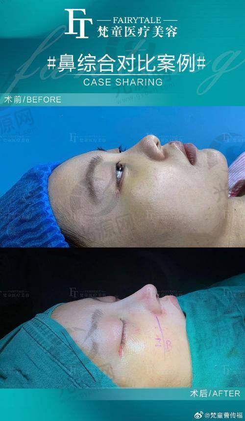 舒铂超肋鼻的稳定性如何？
