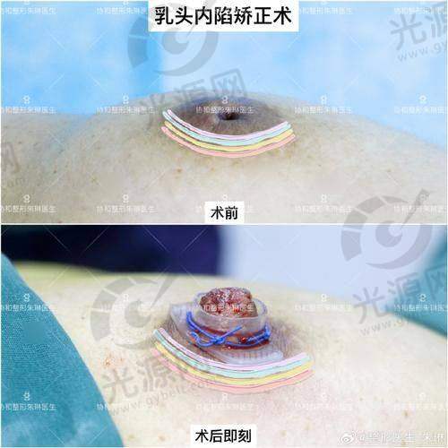 术后护理费用在傲若拉毛面假体中的比重