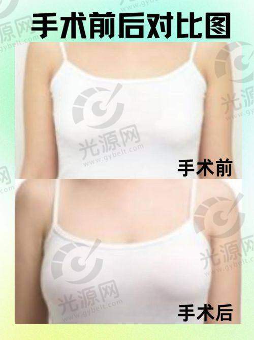 傲若拉毛面假体的术后成效