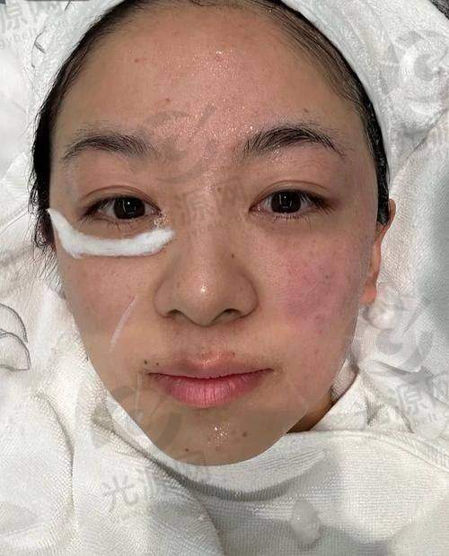 玻尿酸填充的优势与潜在风险