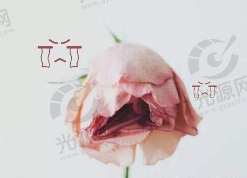 高亮双眼皮修复实例分享