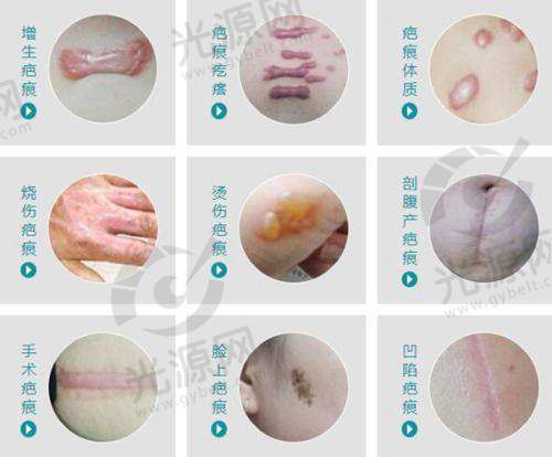 眼袋眶隔释放影响脸型吗？眶隔脂肪释放去眼袋的优缺点解析：术后泪沟凹陷原因、疼痛感及修复方法全揭秘