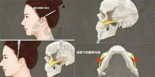 结论：让筋膜提拉术成为你美丽的法宝