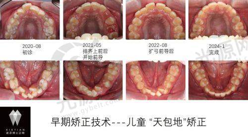 ETA早期矫治技术的成效监测与反馈