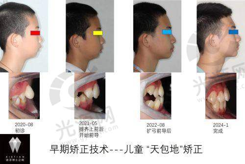 ETA早期矫治技术的舒适性与适用性