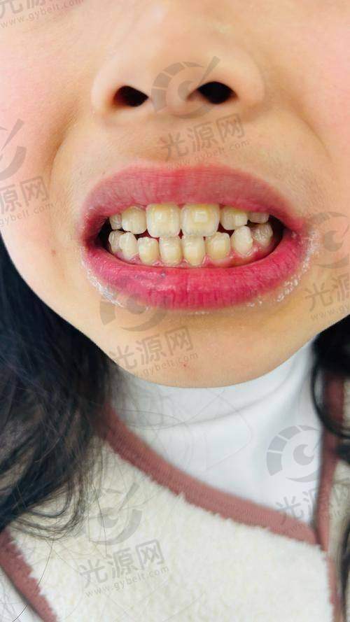 ETA儿童牙齿早期矫正技术详解：费用、优势与效果分析，助力孩子口腔健康成长