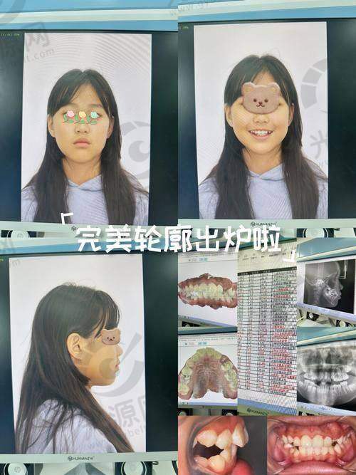 ETA早期矫治技术的成效与实例分析