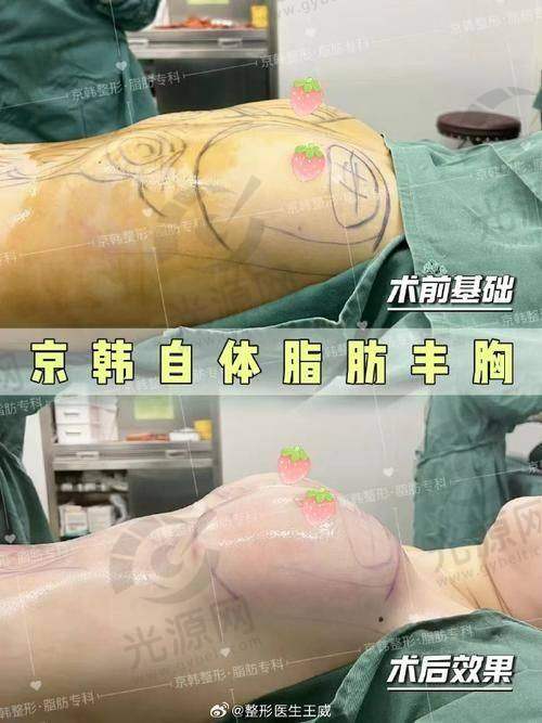 二、泰国假体隆胸医院详细介绍