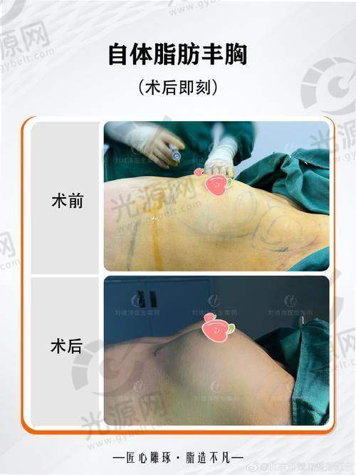 泰国假体隆胸医院排名前10名单与价格揭秘，推荐十家性价比高的医院选择！