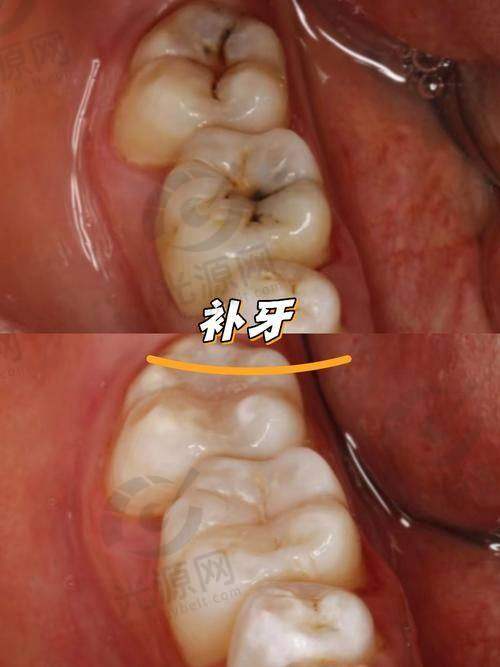 松风和3M树脂区别之美观性
