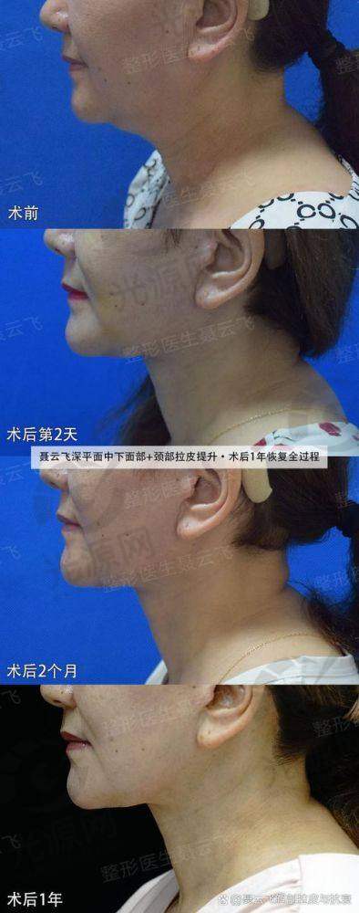 张余光医生：面部拉皮的艺术家