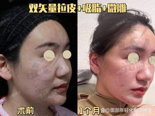 面部提升的术后护理