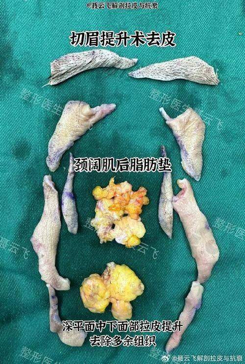 面部提升的费用及预约方式