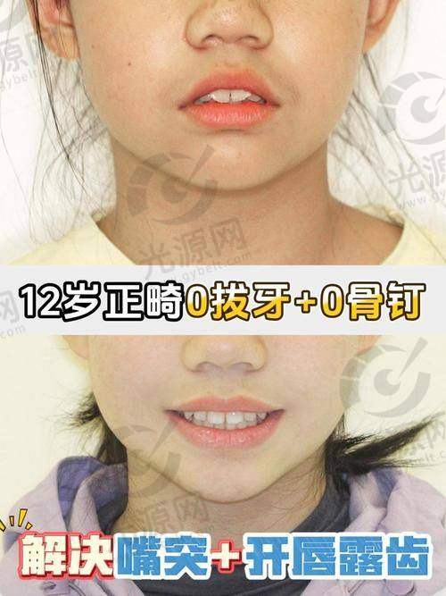 牙齿拥挤如何矫正