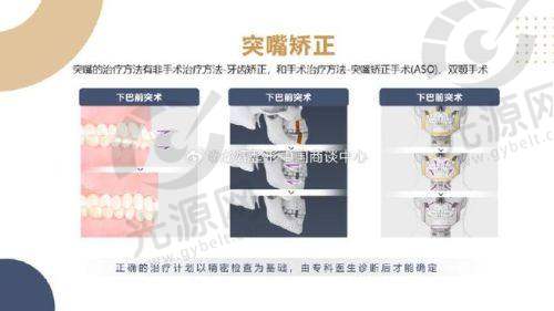 龅牙的临床表现