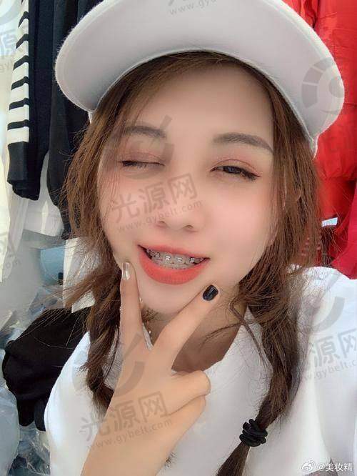 龅牙的矫正方法