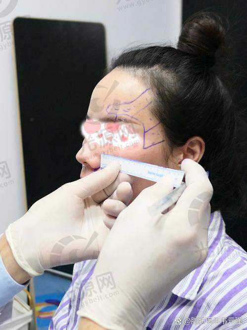 脂肪填充后额头能热敷消肿吗?总结与展望