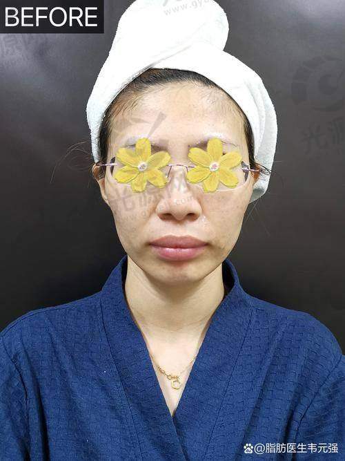 脂肪填充后额头能热敷消肿吗?实际实例分析