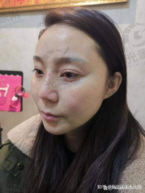 脂肪填充后额头能热敷消肿吗?热敷的风险及替代方案