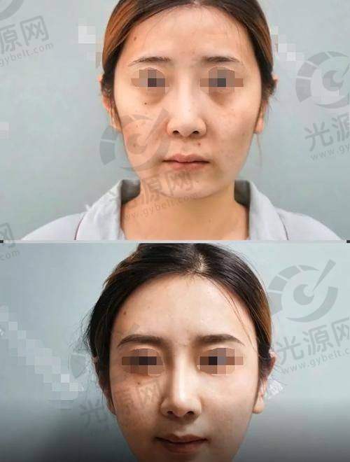 脂肪填充后额头能热敷消肿吗？脂肪填充后热敷的利弊分析：额头能否热敷消肿及处理方法详解