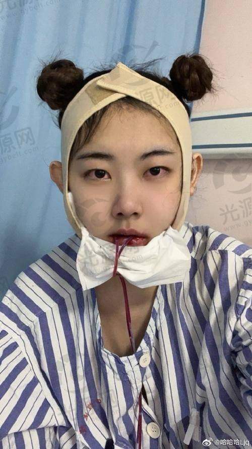 何锦泉正颌手术亲历者的真实反馈