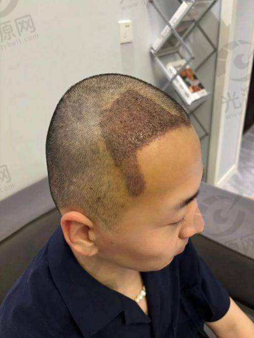 9. 上海艺星植发：国内外化的医疗服务体验