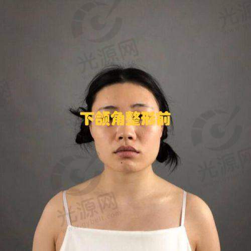 下颌角120度但是方脸的定义