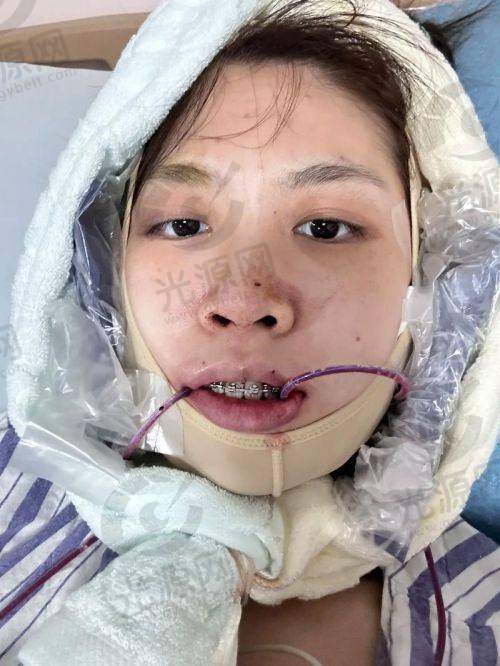 正颌手术成功几率介绍