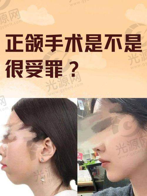 正颌手术成功几率总结与期待