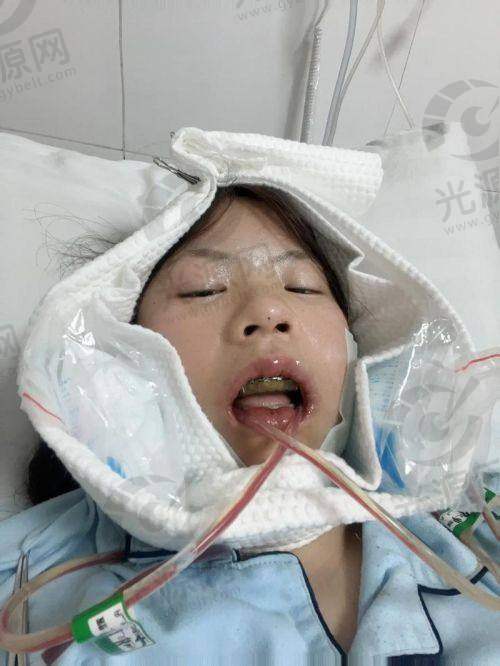 正颌手术成功几率热门实例分析
