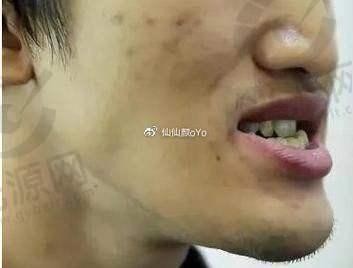 下兜齿一般都是骨性的吗？