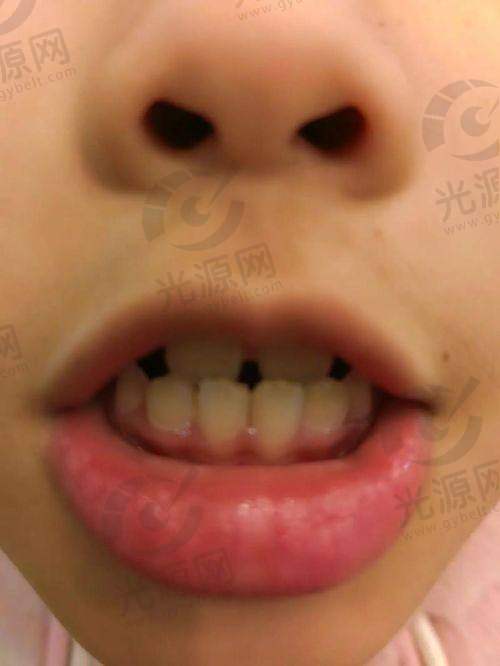 下兜齿的矫正必要性