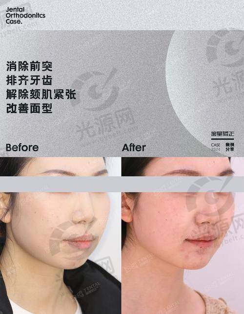 成人深覆合矫正挑战