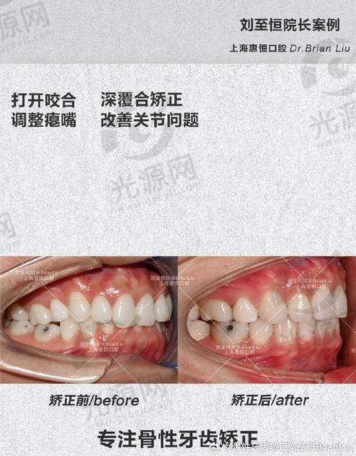 深覆合矫正的美观改变