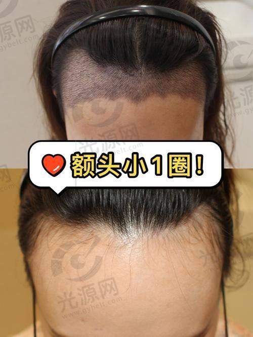 m发际线植发一次更少多少钱分析