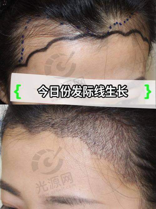 m发际线植发后的护理